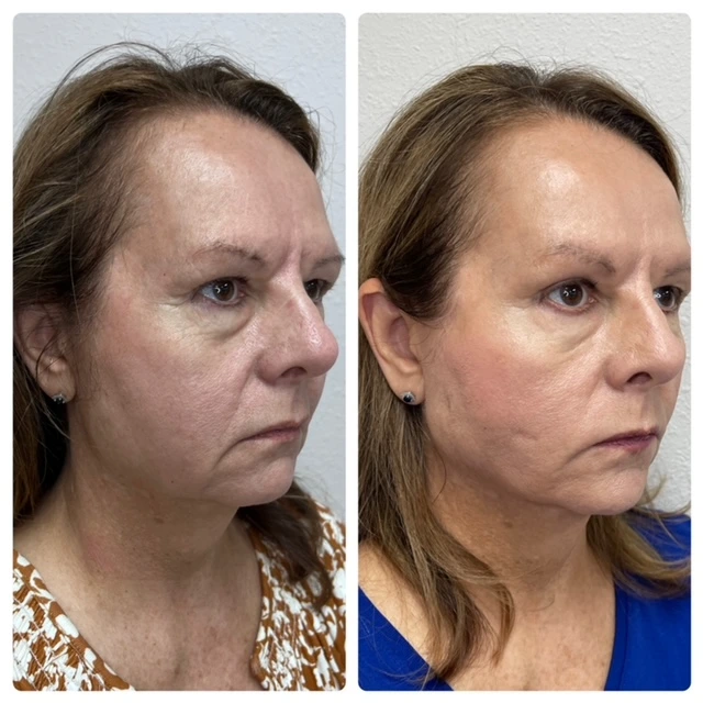 Helix CO2 laser treatment machine for skin resurfacing