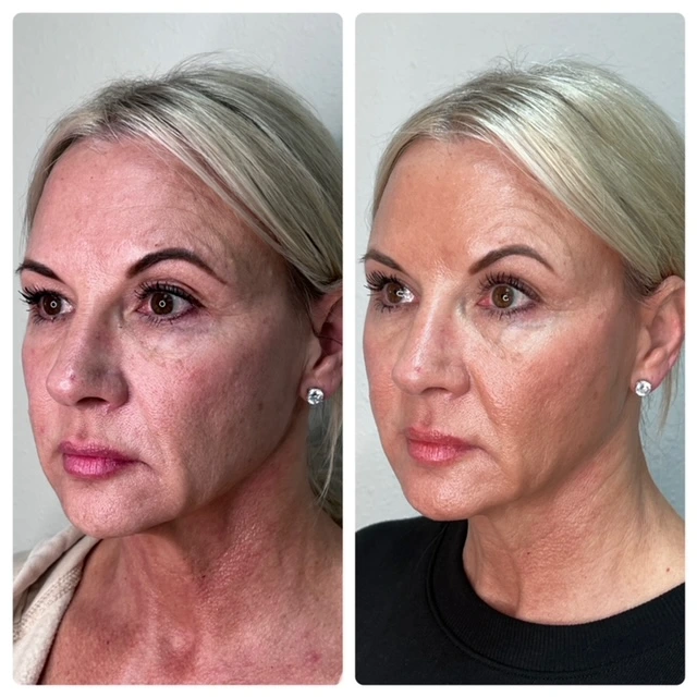 Non-invasive facial rejuvenation before and after