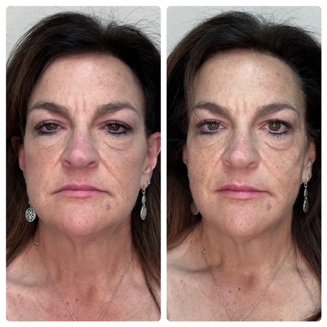Wrinkle reduction and facial rejuvenation treatment