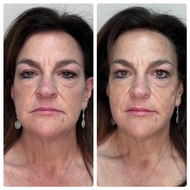 Skin resurfacing treatment before and after photos