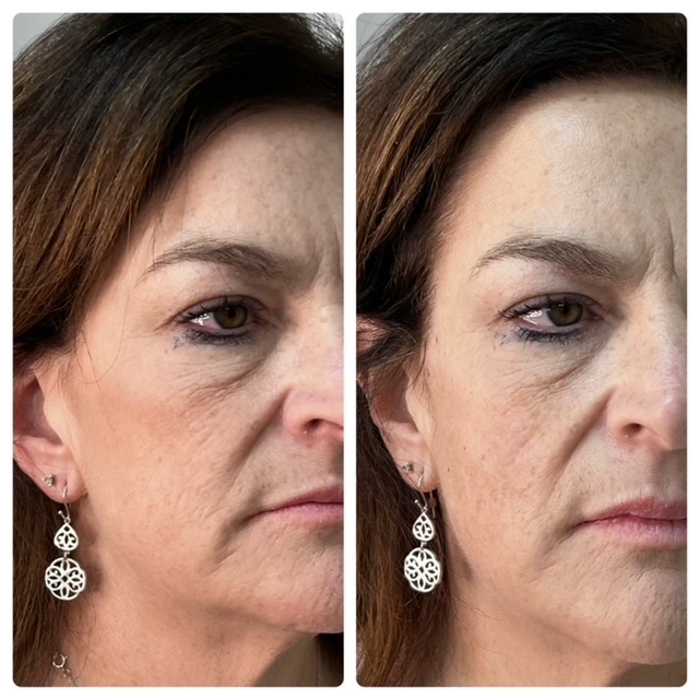 Aesthetic facial contouring and anti-aging results
